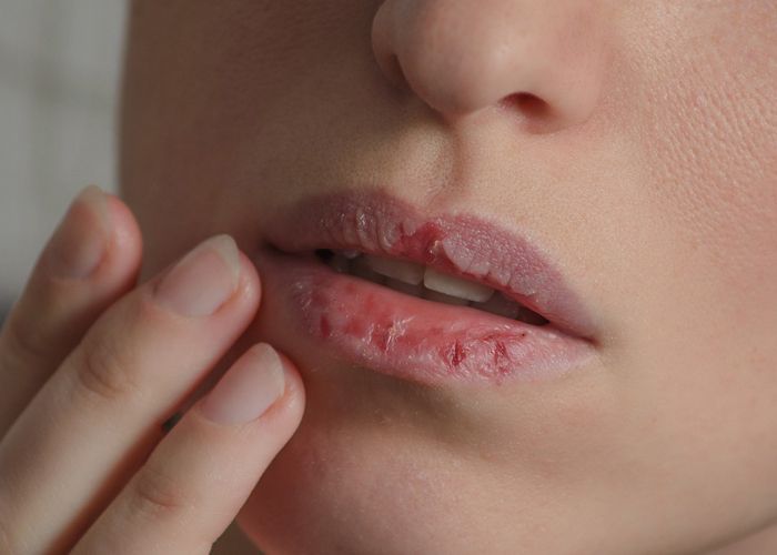 Consejos de tu Clínica dental en cartagena de como no tener los labios secos